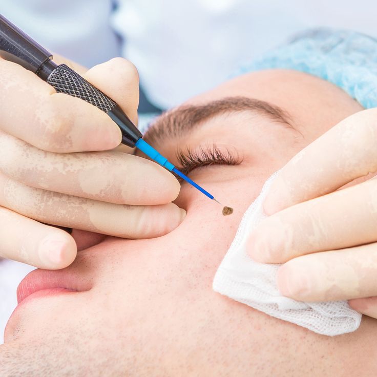 Warts Removal